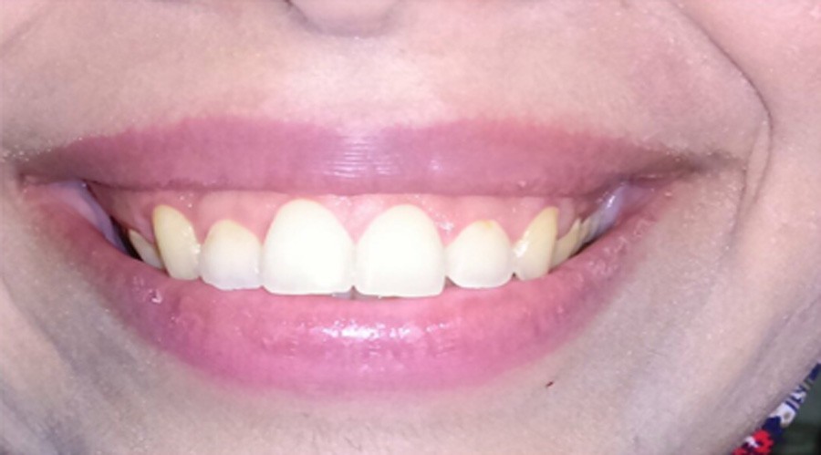 بعد تجميل وعلاج اللثة مركز دكتور ايمن الغمراوى لطب الاسنان 1